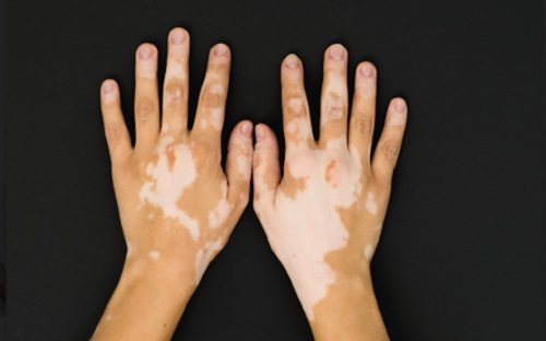 No momento, você está visualizando Amazonas registra mais de 100 casos de vitiligo só neste ano